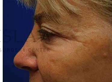 Chemical Peel Before & After Patient #213