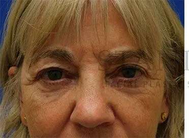 Chemical Peel Before & After Patient #213