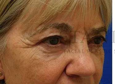 Chemical Peel Before & After Patient #213