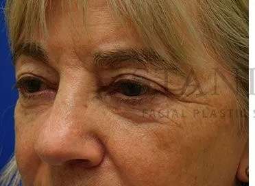 Chemical Peel Before & After Patient #213