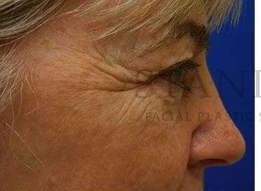 Chemical Peel Before & After Patient #213