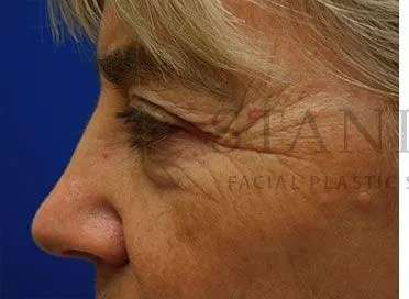Chemical Peel Before & After Patient #213