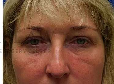 Chemical Peel Before & After Patient #197