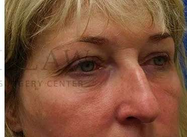 Chemical Peel Before & After Patient #197