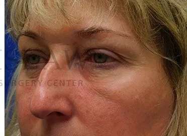 Chemical Peel Before & After Patient #197