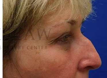 Chemical Peel Before & After Patient #197