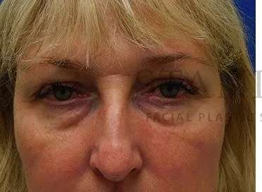Chemical Peel Before & After Patient #197