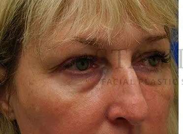 Chemical Peel Before & After Patient #197