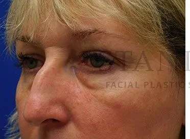 Chemical Peel Before & After Patient #197