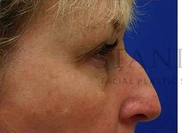 Chemical Peel Before & After Patient #197