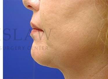Chin Augmentation Before & After Patient #281