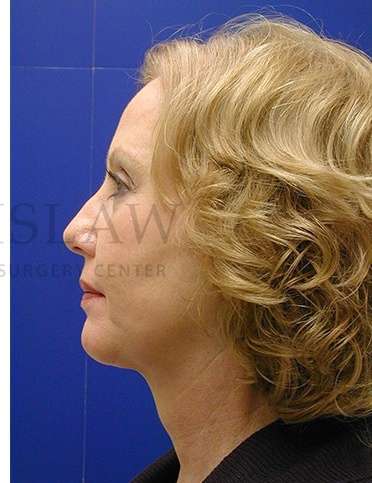 Chin Augmentation Before & After Patient #281