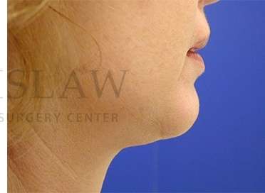 Chin Augmentation Before & After Patient #281
