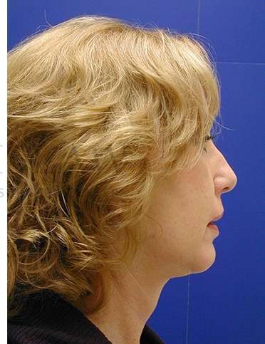 Chin Augmentation Before & After Patient #281