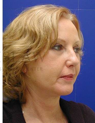 Chin Augmentation Before & After Patient #281