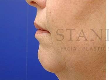 Chin Augmentation Before & After Patient #281
