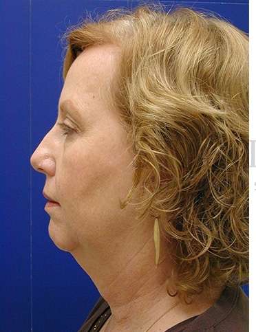 Chin Augmentation Before & After Patient #281