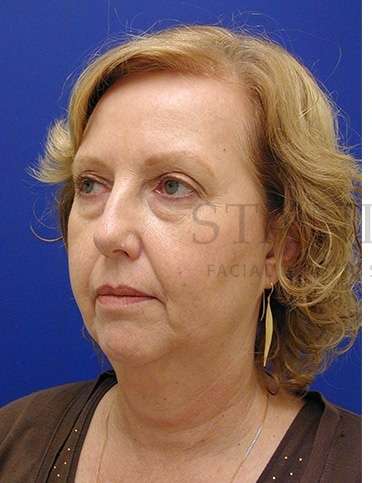 Chin Augmentation Before & After Patient #281