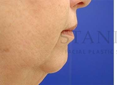 Chin Augmentation Before & After Patient #281