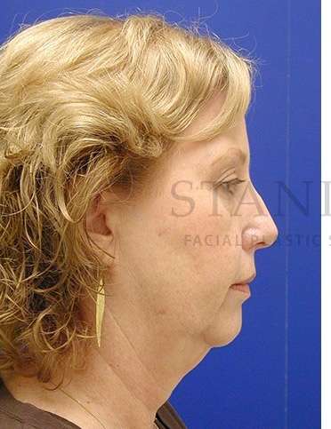 Chin Augmentation Before & After Patient #281