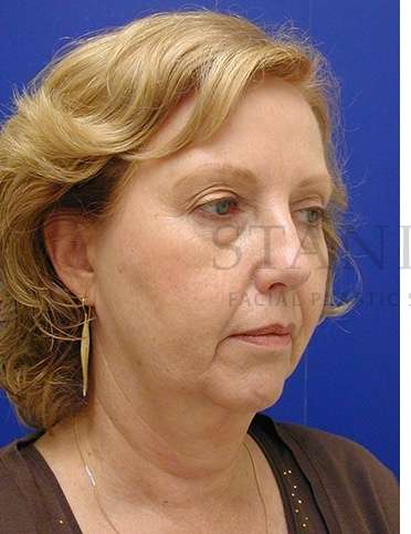 Chin Augmentation Before & After Patient #281