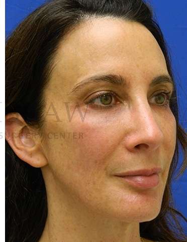 Chin Augmentation Before & After Patient #268