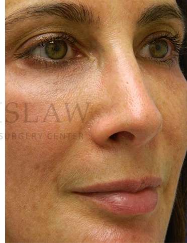 Chin Augmentation Before & After Patient #268