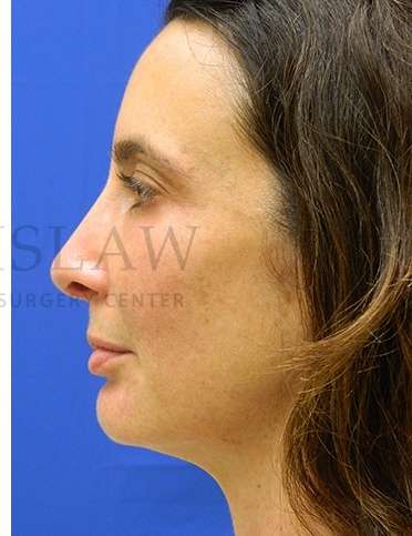 Chin Augmentation Before & After Patient #268