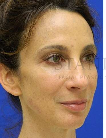 Chin Augmentation Before & After Patient #268
