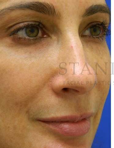 Chin Augmentation Before & After Patient #268