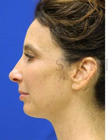 Chin Augmentation Before & After Patient #268
