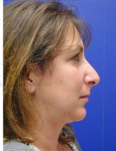 Chin Augmentation Before & After Patient #261