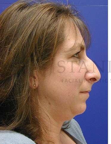 Chin Augmentation Before & After Patient #261