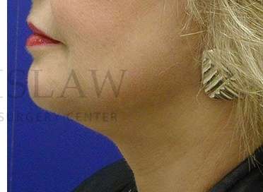 Chin Augmentation Before & After Patient #256
