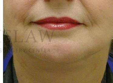 Chin Augmentation Before & After Patient #256