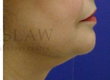Chin Augmentation Before & After Patient #256