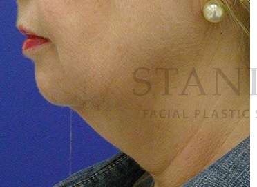 Chin Augmentation Before & After Patient #256