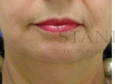 Chin Augmentation Before & After Patient #256