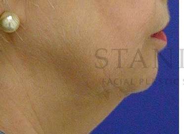 Chin Augmentation Before & After Patient #256