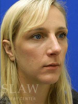 Chin Augmentation Before & After Patient #292