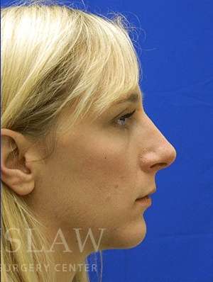 Chin Augmentation Before & After Patient #292