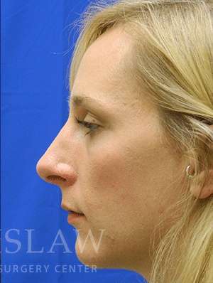 Chin Augmentation Before & After Patient #292
