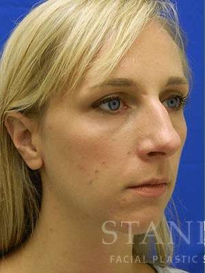 Chin Augmentation Before & After Patient #292