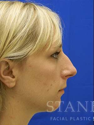 Chin Augmentation Before & After Patient #292