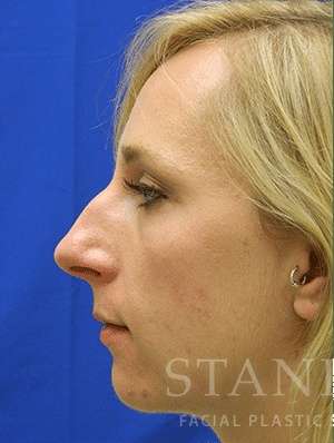 Chin Augmentation Before & After Patient #292