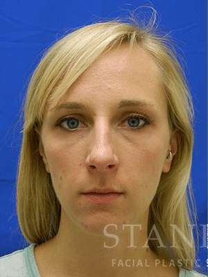 Chin Augmentation Before & After Patient #292