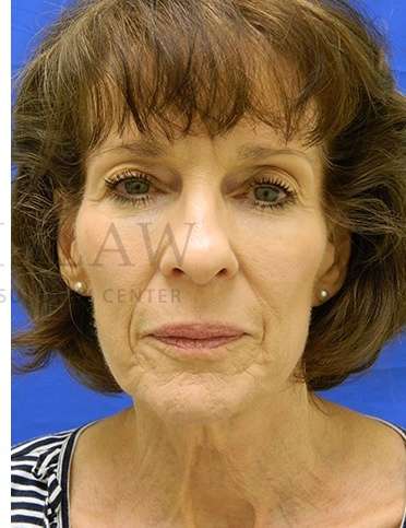 Collagen Induction Therapy Before & After Patient #305