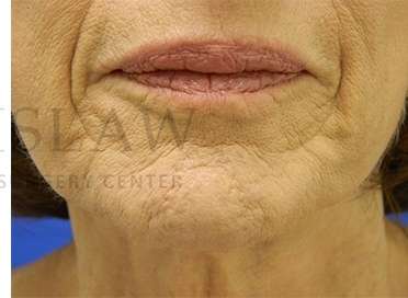 Collagen Induction Therapy Before & After Patient #305