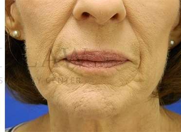 Collagen Induction Therapy Before & After Patient #305
