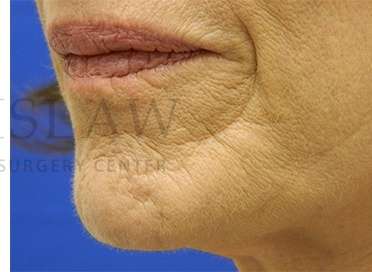 Collagen Induction Therapy Before & After Patient #305